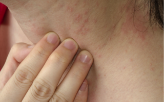 Как уменьшить проявления аллергии на коже домашними методами