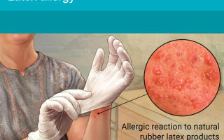 Аллергия на латекс: причины, проявления и диагностика