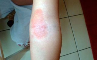 Аллергия на ромашку аптечную