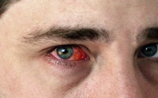 Красные глаза при аллергии