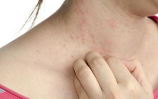 Жжение при аллергии на коже и слизистых оболочках