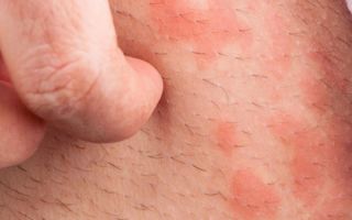 Аллергия половых органов – симптомы и лечение