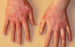 Аллергия на холод на руках: характерные симптомы и как лечить заболевание