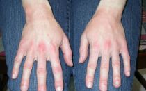Аллергия на перчатки: симптомы, лечение, рекомендации и препараты