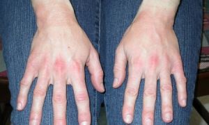 Аллергия на перчатки: симптомы, лечение, рекомендации и препараты