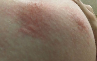 Аллергия на груди, под грудью