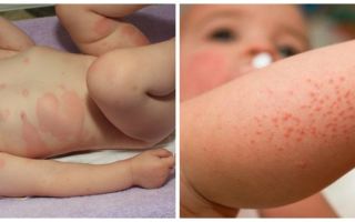 Капустная аллергия у взрослых и детей