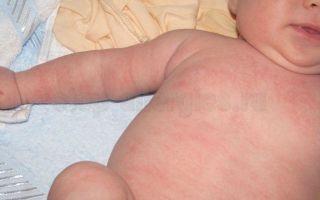 Аллергическая реакция детей на молочные продукты питания “агуша”