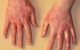 Что мы знаем о аллергических заболеваниях кожи