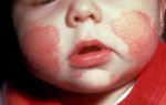 Аллергия на мимозу: лечение и профилактика
