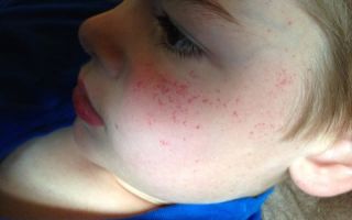 Аллергия на прополис