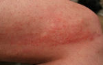 Аллергия на сырость: симптомы, лечение, профилактика